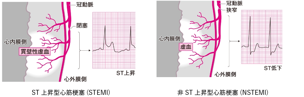 STEMI/NSTEMIの治療法