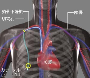 カテーテル留置経路の図