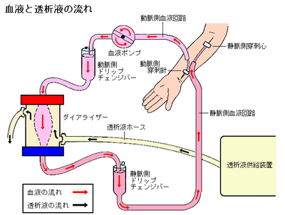 図：血液透析の仕組み