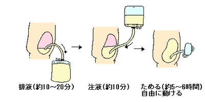 イメージイラスト：CAPD（連続腹膜透析）