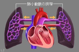 肺小動脈が狭窄している様子の図