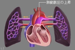 肺動脈圧が上昇した様子の図