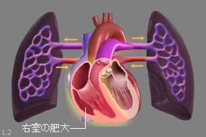 右心負荷により、右室が拡大した図