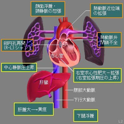 肺高血圧症の病態と主な症状を示した図