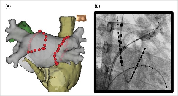 Figure 1. Catheter ablation