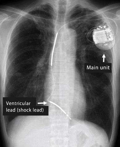 Figure 2. Radiograph after implantation of an implantable cardioverter-defibrillator