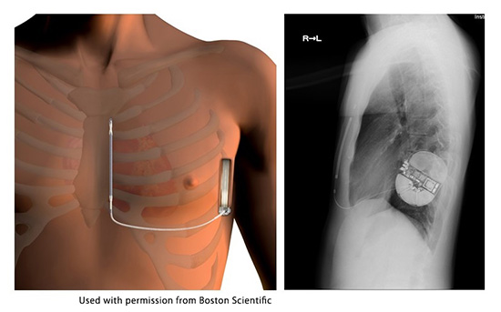 Figure 3. Subcutaneous implantable cardioverter-defibrillator