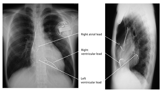 Figure 4. Radiographs showing cardiac resynchronization therapy