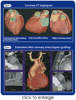 Coronary CT angiogram