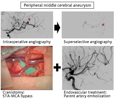 Peripheral middle cerebral aneurysm