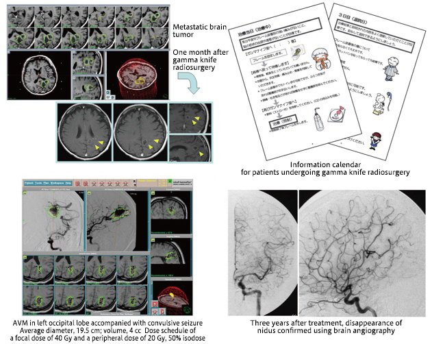 Gamma knife radiosurgery