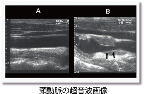 頸動脈の超音波画像