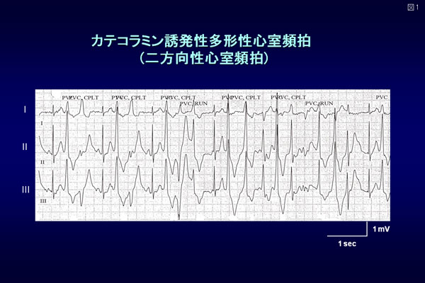 図1.カテコラミン誘発性多形性心室頻拍患者で認めた特徴的な二方向性心室頻拍
