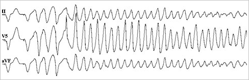 図7. 心室細動の誘発