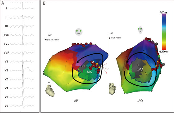 図4. 3次元マッピング装置によるマクロリエントリ性心房頻拍の診断（B）