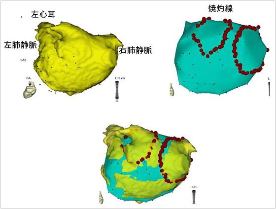 図6. 心房細動のアブレーション（肺静脈隔離術）