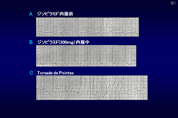 Ia群抗不整脈薬（ジソピラミド）によるQT延長とTorsade de Pointes