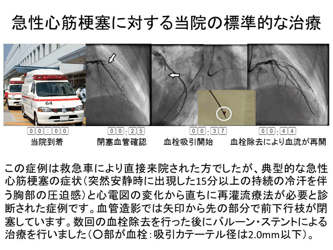 急性心筋梗塞に対する当院の標準的な治療