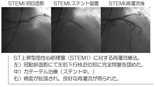 STEMI