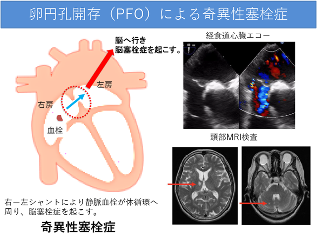 卵円孔開存(PFO)による奇異性塞栓症