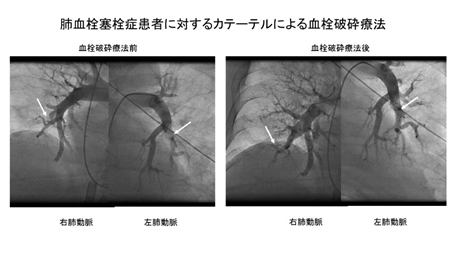 肺血栓塞栓症患者に対するカテーテルによる血栓破砕療法