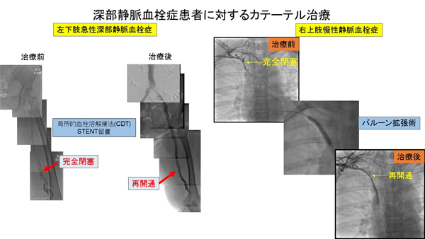 深部静脈血栓症患者に対するカテーテル治療