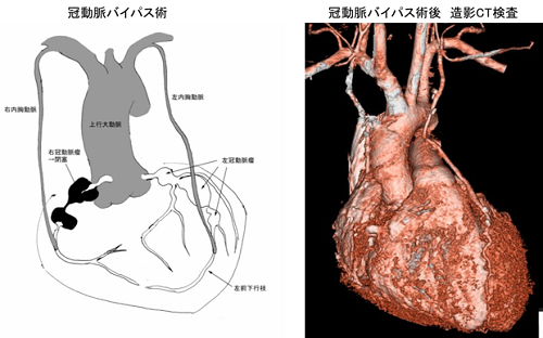 EC-ICバイパスの費用はいくらですか?