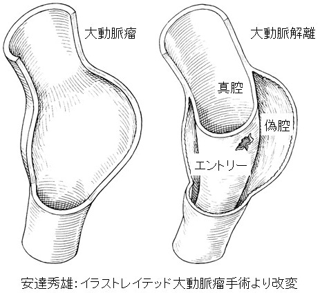 胸部大動脈（大動脈瘤と大動脈解離）｜血管外科｜心臓血管外科部門