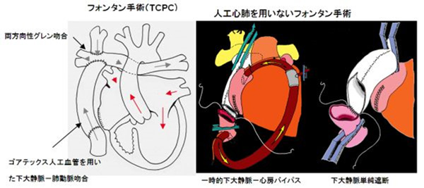 フォンタン手術（TCPC）