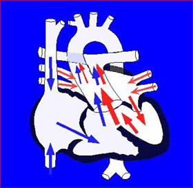 総動脈幹症（Truncus Arteriosus）