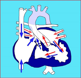 僧帽弁閉鎖症（Mitral Atresia : MA）