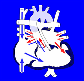 単心室症（Single Ventricle : SV, Univentricular Heart : UVH）