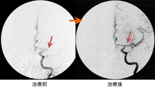 図1. 血栓溶解療法による脳血管の再開通