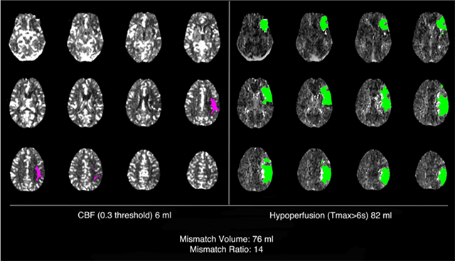 ＜図1＞RAPIDによる急性期脳梗塞のCT灌流画像解析マップ．