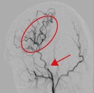 Moyamoya disease