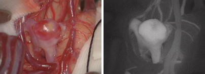 The image on the left shows a brain aneurysm before clipping. A tumor can be seen in a cerebral blood vessel.／The image on the right shows intravenous injection of a fluorescent pigment. The aneurysm and normal blood vessels appear white.