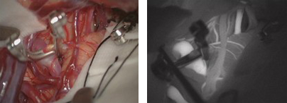 The image on the left shows clipping at the root (cervix) of the aneurysm.／The image on the right was captured after intravenous injection of a fluorescent pigment. Normal blood vessels appear white but not the aneurysm, indicating that blood flow to the aneurysm has been blocked.