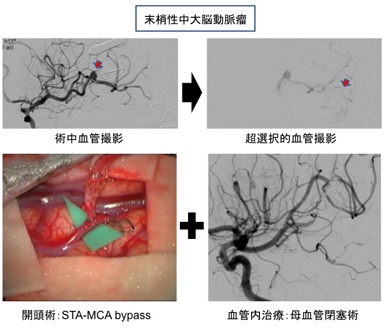 末梢生中大脳動脈瘤