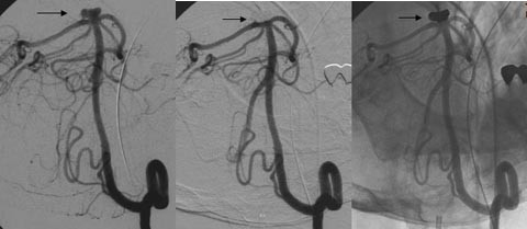 Cerebral aneurysm coil embolization (endovascular treatment)