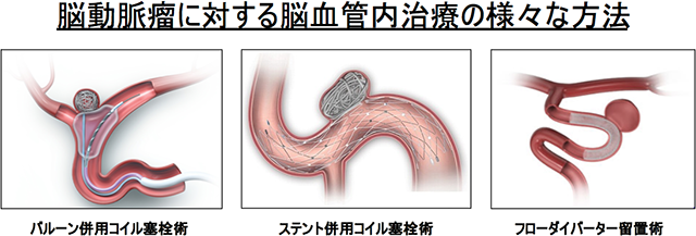 脳動脈瘤に対する脳血管内治療の様々な方法