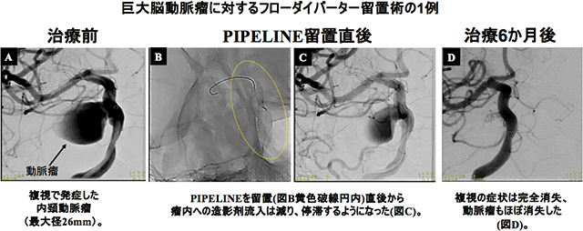 巨大脳動脈瘤に対するフローダイバーター留置術の1例