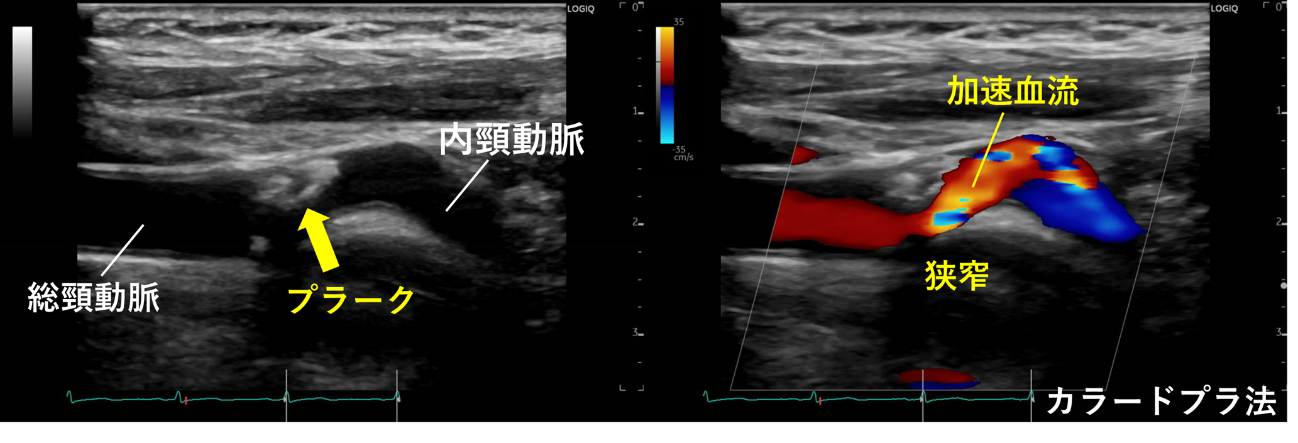 頚動脈 エコー 検査 結果 の 見方