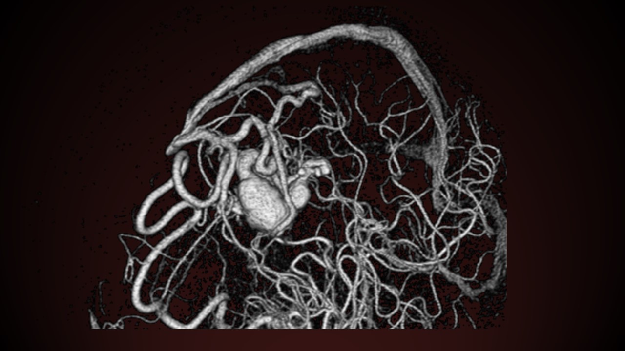 脳動静脈奇形