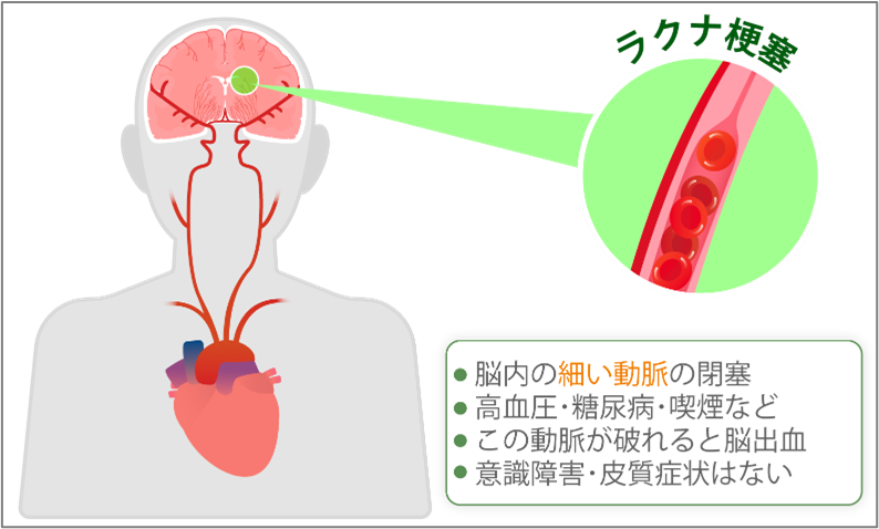 血管は全てを繋げる臓器！血管と脳のための【新世代オメガ3 サプリ】抗炎症