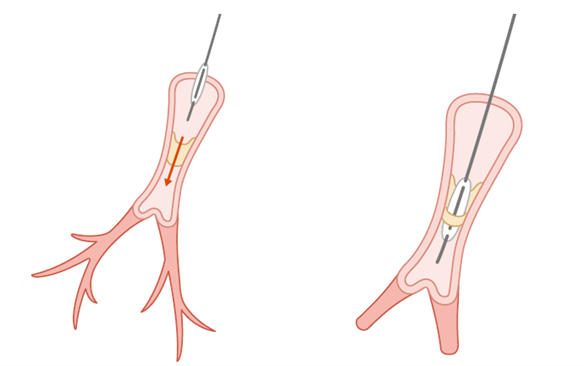 肺動脈バルーンカテーテル治療