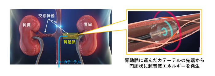 腎デナベーションのメカニズム