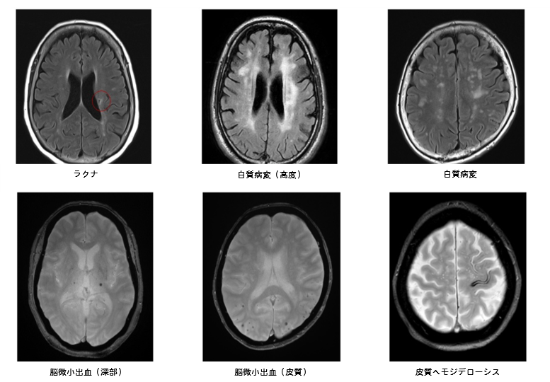 脳小血管病（SVD）の各表現型