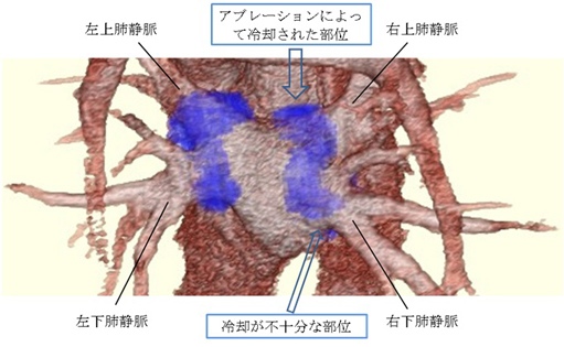 Mishima, Miyamoto et al. Heart Rhythm Case Reports 2015