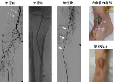 図１　30歳代女性、閉塞した大腿膝窩動脈の治療