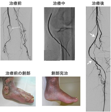 図２　60歳代男性、　閉塞したバイパスの治療